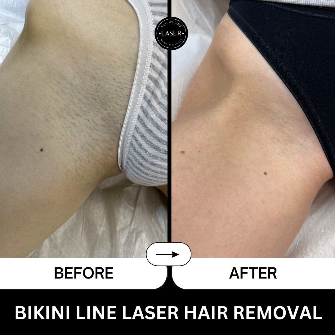 Bikini laser hot sale hair removal